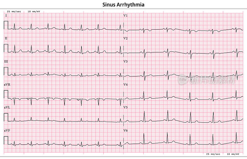心电图窦性心律失常- 12导联心电图常见病例- 6秒/导联